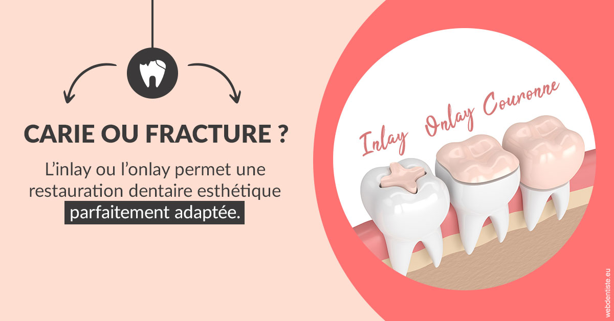 https://dr-stephanie-cohere-martin.chirurgiens-dentistes.fr/T2 2023 - Carie ou fracture 2