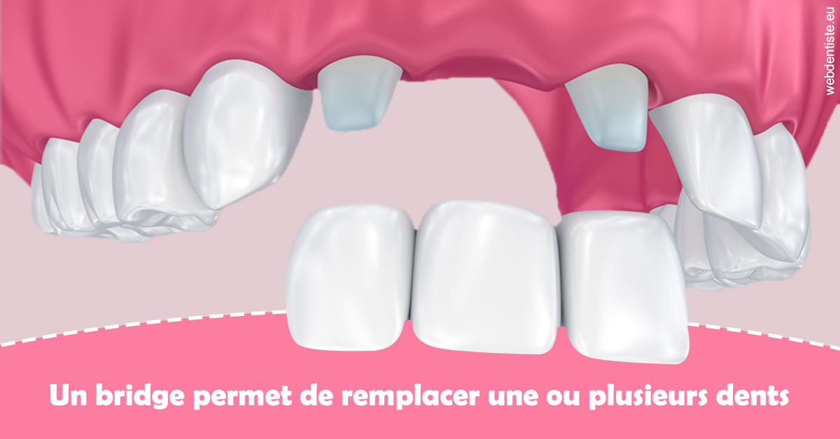 https://dr-stephanie-cohere-martin.chirurgiens-dentistes.fr/Bridge remplacer dents 2