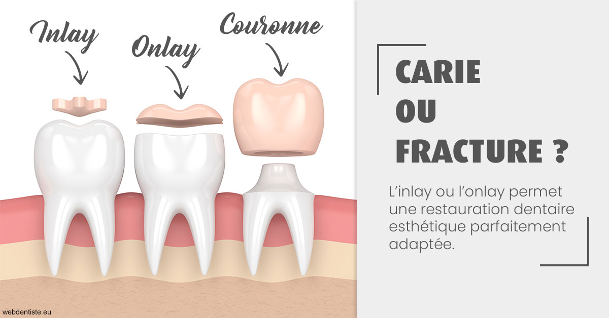 https://dr-stephanie-cohere-martin.chirurgiens-dentistes.fr/T2 2023 - Carie ou fracture 1
