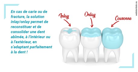 https://dr-stephanie-cohere-martin.chirurgiens-dentistes.fr/L'INLAY ou l'ONLAY