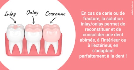 https://dr-stephanie-cohere-martin.chirurgiens-dentistes.fr/L'INLAY ou l'ONLAY 2