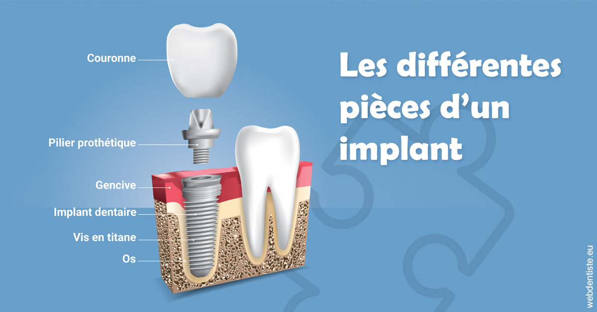https://dr-stephanie-cohere-martin.chirurgiens-dentistes.fr/Les différentes pièces d’un implant 1